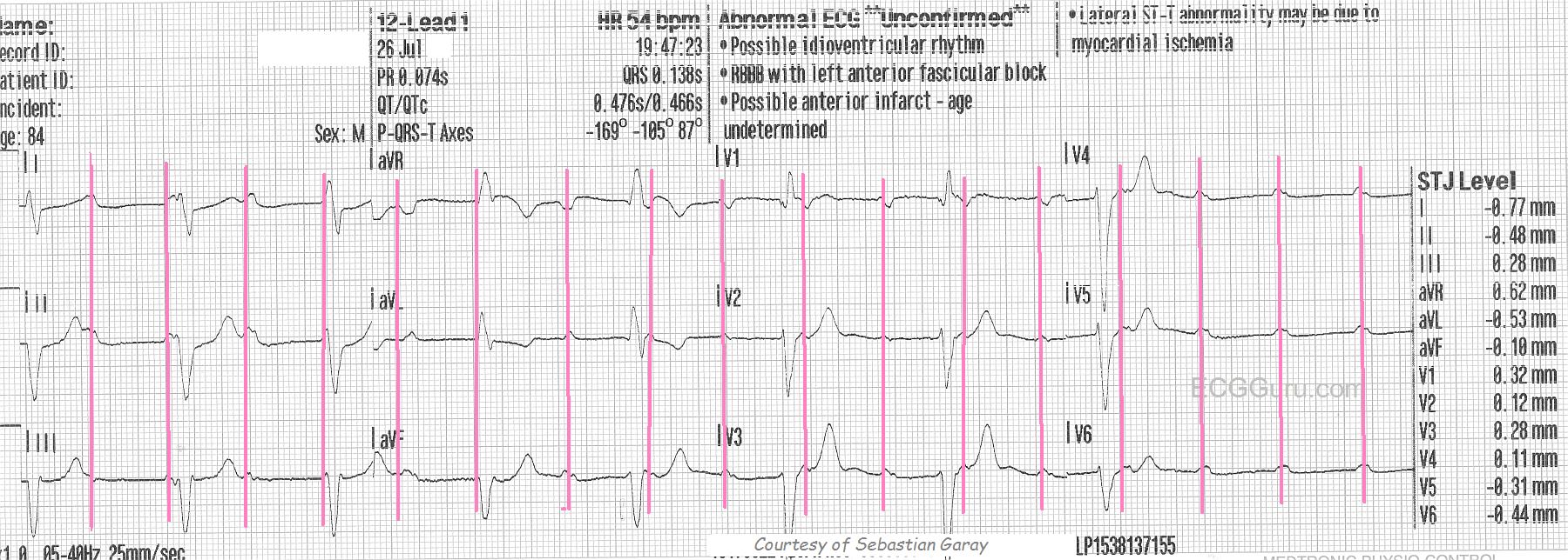 Distinction Ⅰ〜Ⅲ、vocavularist、 2000 High-grade AV Block | ECG Guru - Instructor Resources